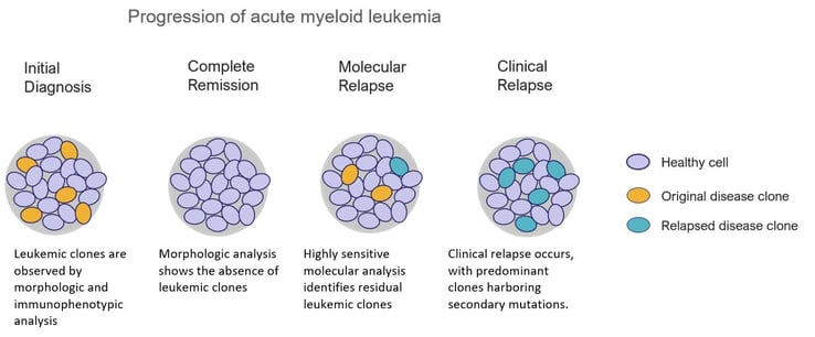 progression-of-acute-myeloid-leukemia-Oncomine
